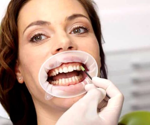 Fluorizarea profesionala locala